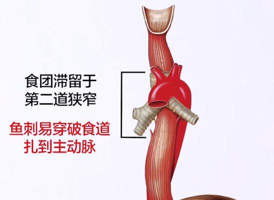 鱼刺卡食道怎么办？如何安全取出？